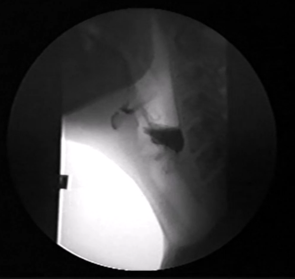 Image showing UES dysfunction